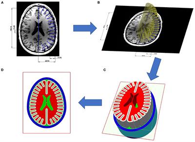 Localizing Clinical Patterns of Blast Traumatic Brain Injury Through Computational Modeling and Simulation